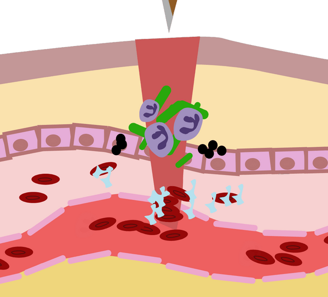 Inflammation swelling