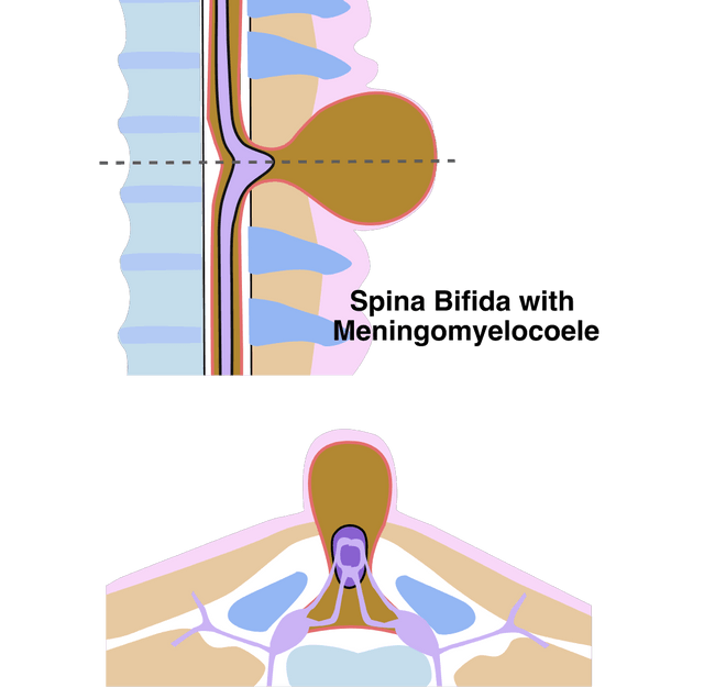 Spina bifida 2 views