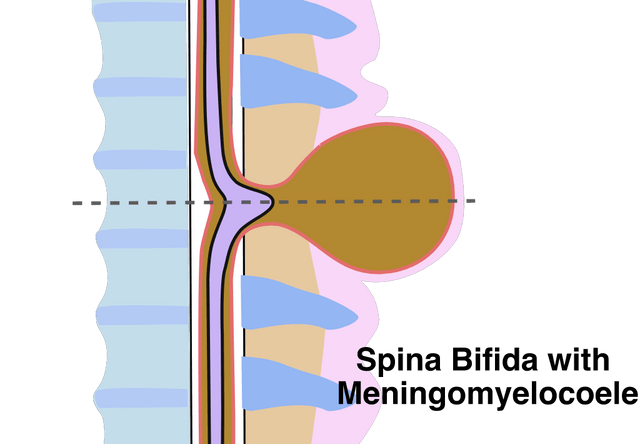 spina bifida 1 section complete