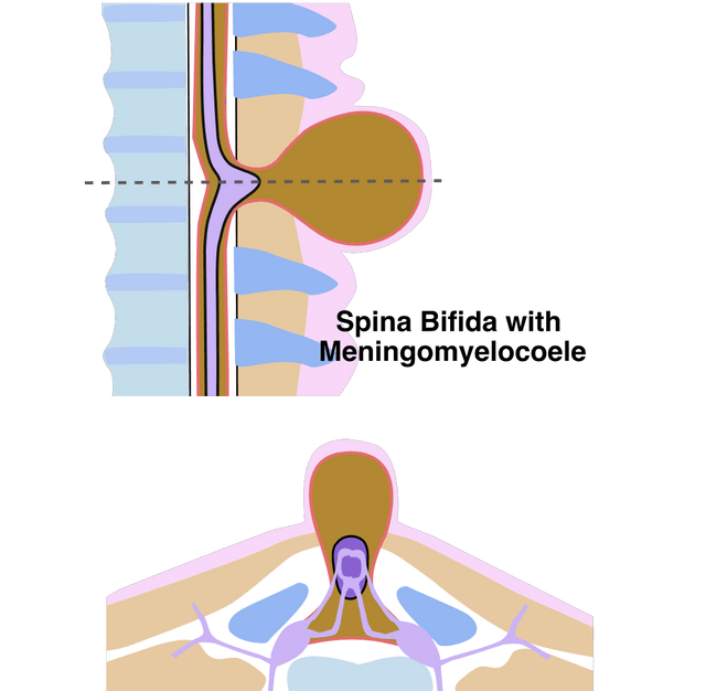 Spina bifida 2 views complete