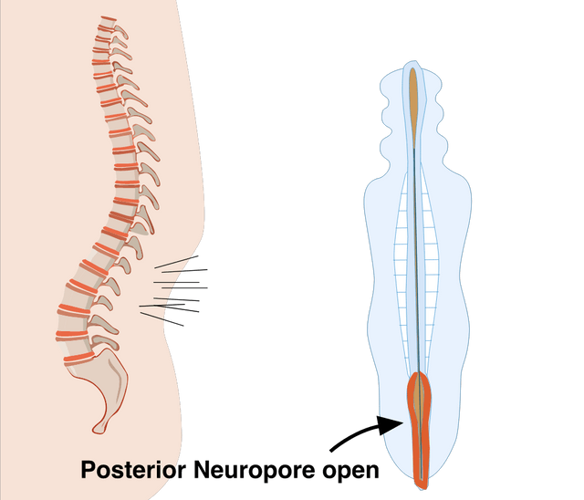 spina bifida 1
