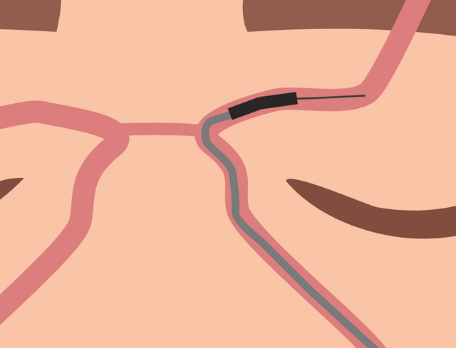 Thrombectomy