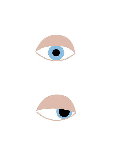 Cranial nerve III Palsy