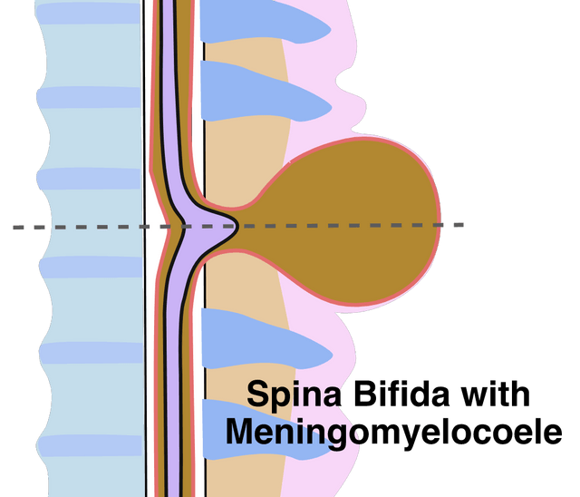 spina bifida 2