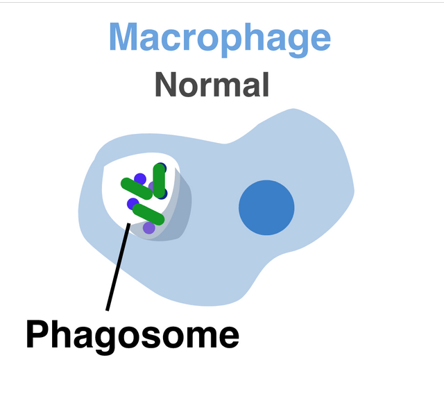 Chronic inflammation Tuberculosis
