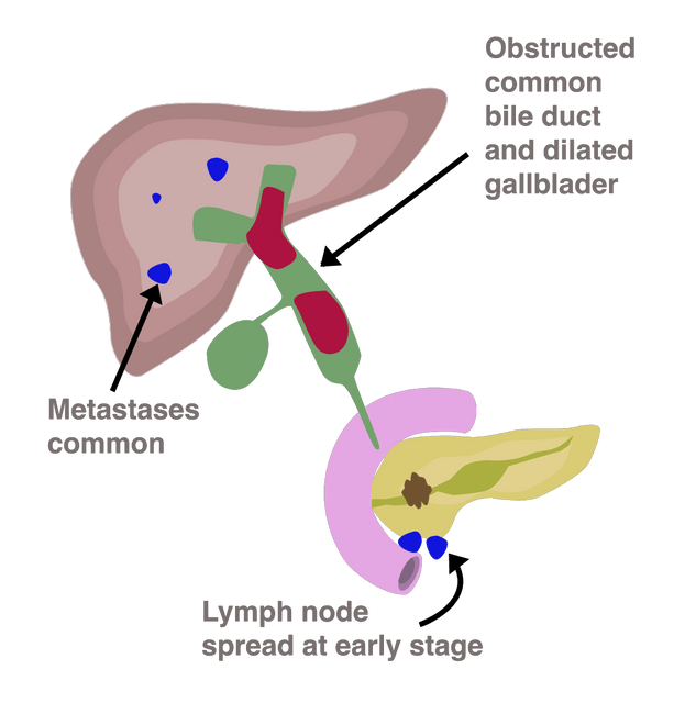 Pancreatic cancer