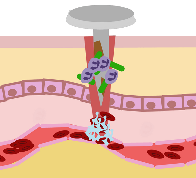 Accute inflammation nail, formation of placelets and neutrophil action